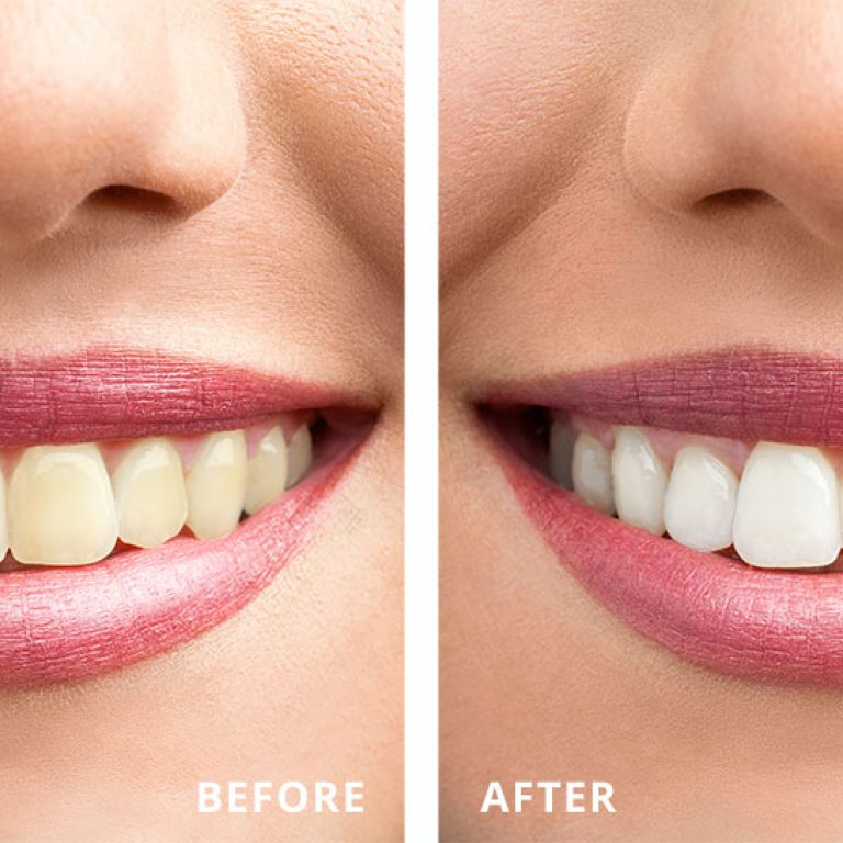 northgate-dental-sinsational-smile-teeth-whitening-before-after