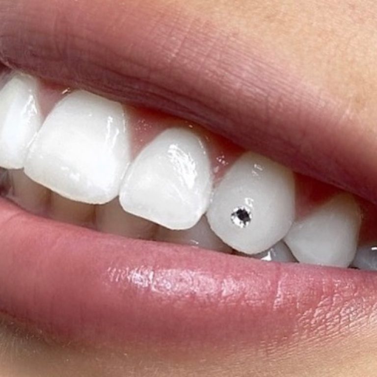 tooth-gems-cosmetic-dentistry-teeth-gems-best-dentist-in-tijuana-tooth-piercing-tijuana-mexico-teeth-gems